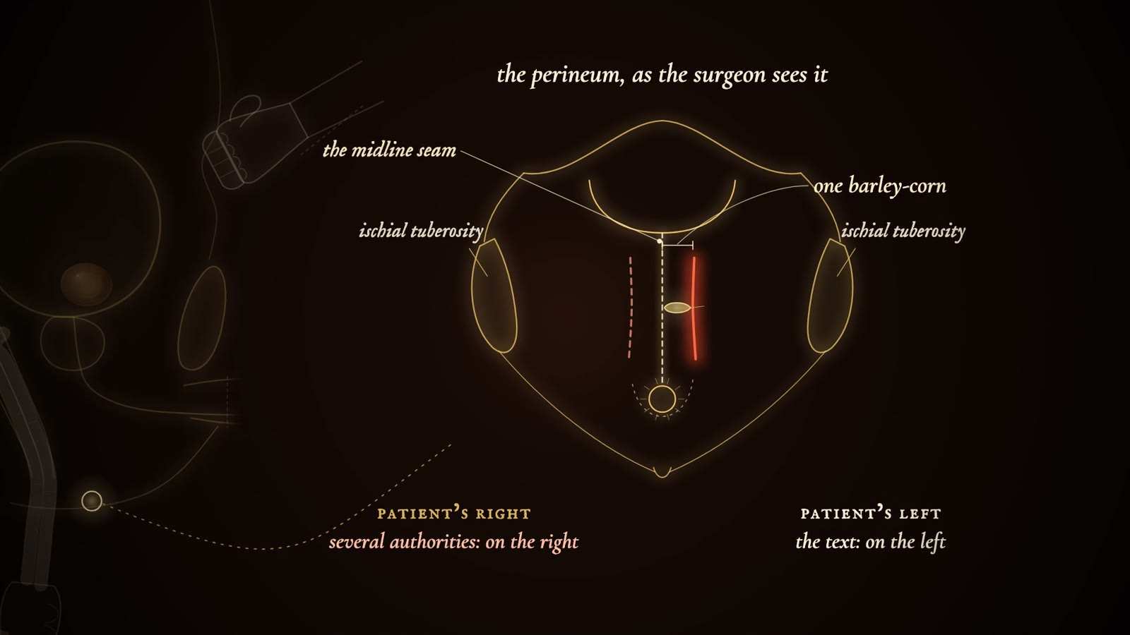 Gold-line diagram titled the perineum, as the surgeon sees it, with midline seam, ischial tuberosities, one barley-corn and a red incision on the left.